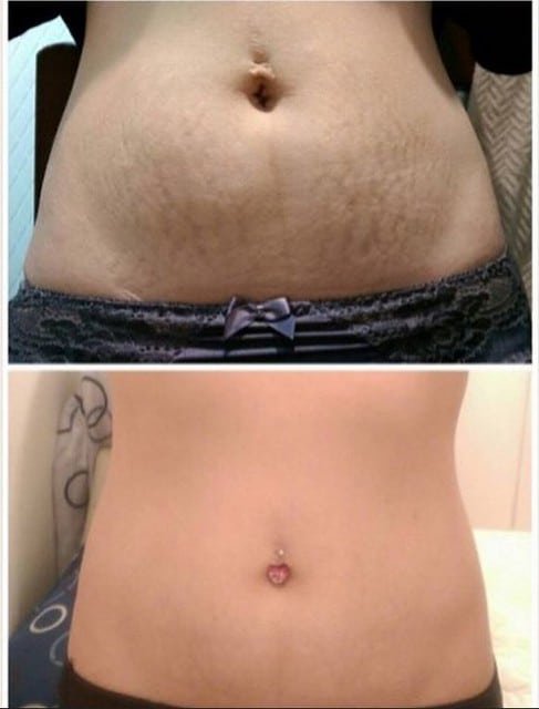 Pentaxyl review before and after stretch marks photo by @keirstcaird