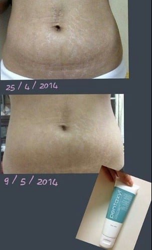 Pentaxyl review before and after stretch marks photo by @hkbeautyg