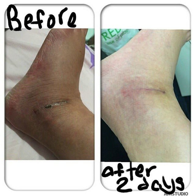 Pentaxyl review before and after ankle scar photo by @jaclynlim1313