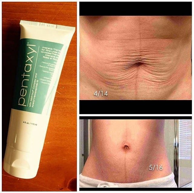Pentaxyl review before and after belly photo by @mhk_health_beauty