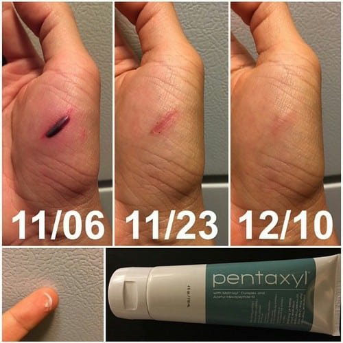 Pentaxyl review before and after blood blister photo by @suttar85