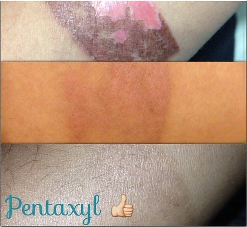 Pentaxyl review before and after burn photo by @chocomanalo
