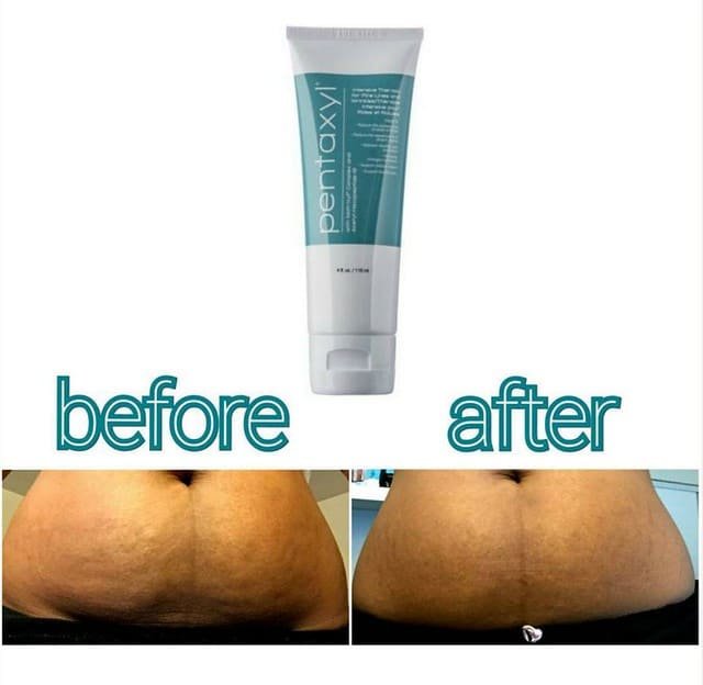 Pentaxyl review before and after stretch marks photo by @triggertris