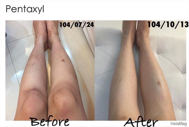 Pentaxyl review before and after legs photo by @hsuanhankuo
