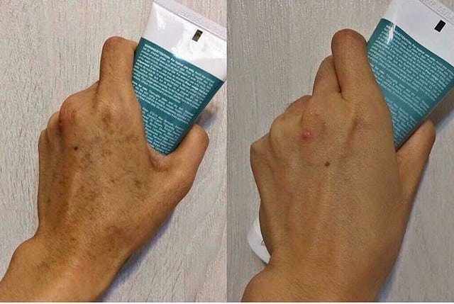 Pentaxyl review before and after age spots photo by @michelle15923
