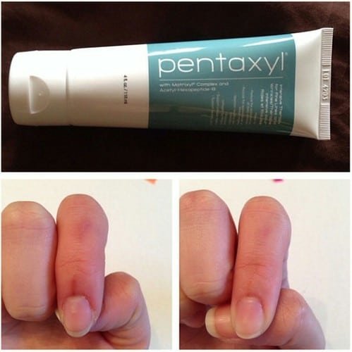 Pentaxyl review before and after scar photo by @jessicaxcb