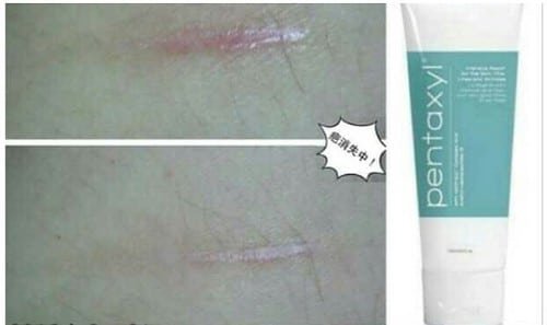 Pentaxyl review before and after scar photo by @weiwei1902