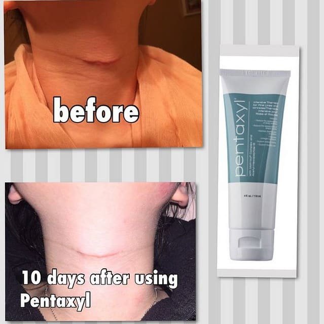 Pentaxyl review before and after surgery scar photo by @shake_ur_beauty