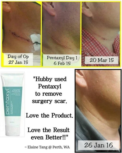 Pentaxyl review before and after scar photo by @elaine_tanglee