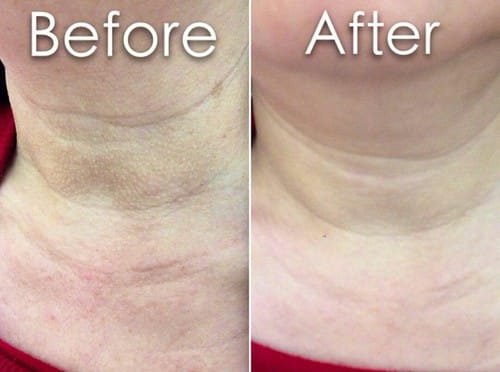 Pentaxyl review before and after wrinkles photo by @bruceweii