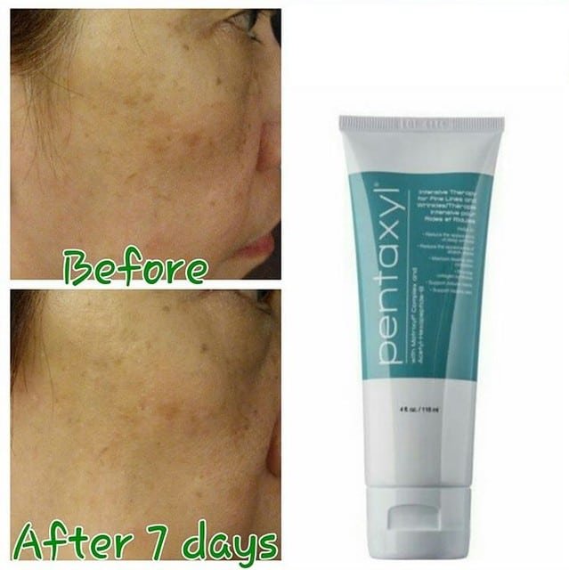 Pentaxyl review before and after freckles photo by @lindatan80