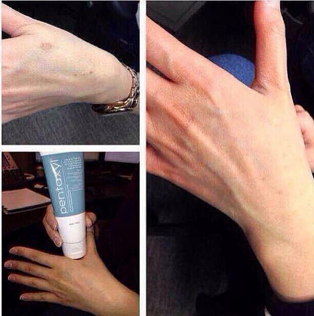Pentaxyl review before and after dark spot photo by @mayng5031_motives