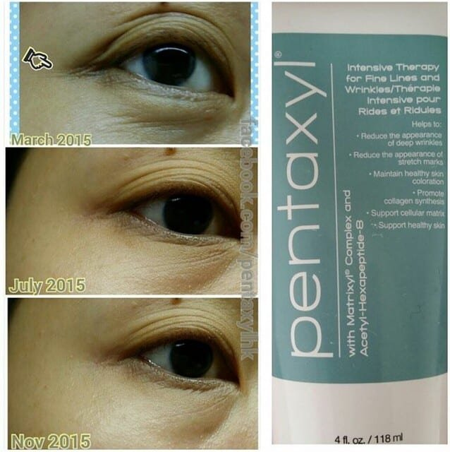 Pentaxyl review before and after crow's feet photo by @siugoo99