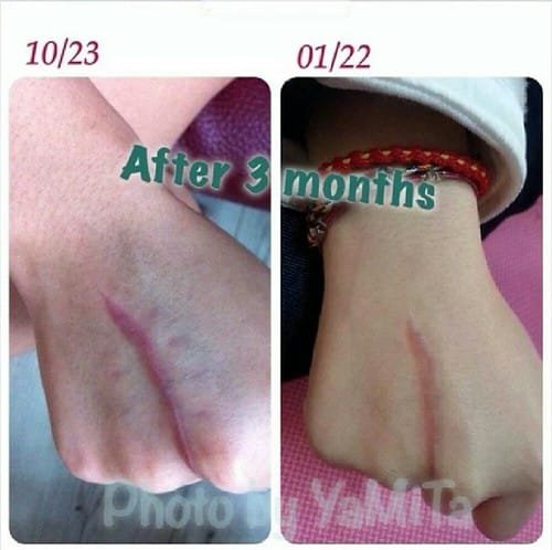 Pentaxyl review before and after scar photo by @alyn_yeh