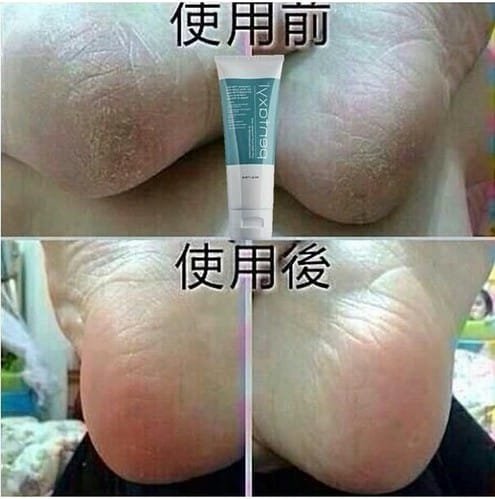 Pentaxyl review before and after dry feet photo by @hkbeautyg