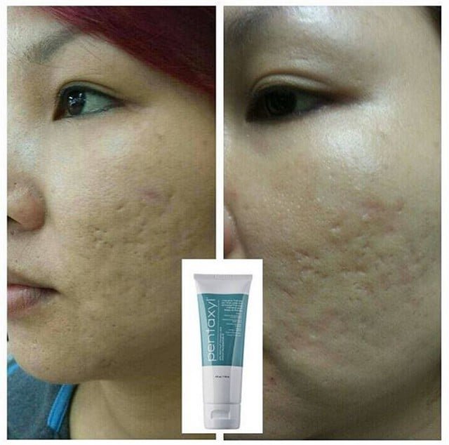 Pentaxyl review before and after pockmarks photo by @babiesworks