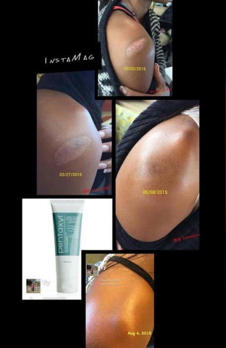 Pentaxyl review before and after burn photo by @weiwei1902